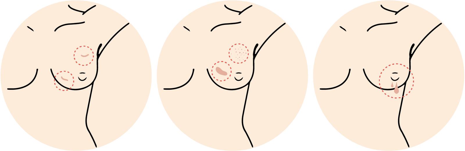 How to self check for breast cancer by looking