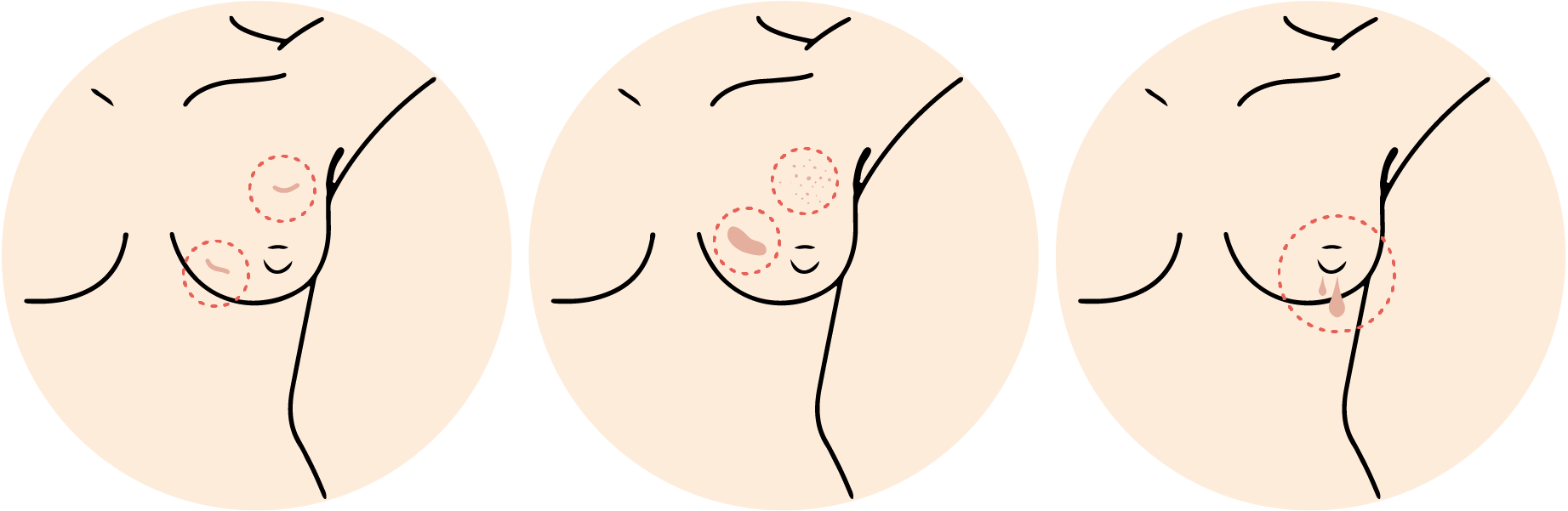 How to self check for breast cancer by looking